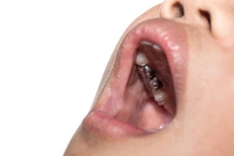 Dental Crowns Kids
