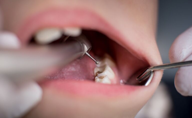 Photo of a child in need of baby teeth removal for better oral health