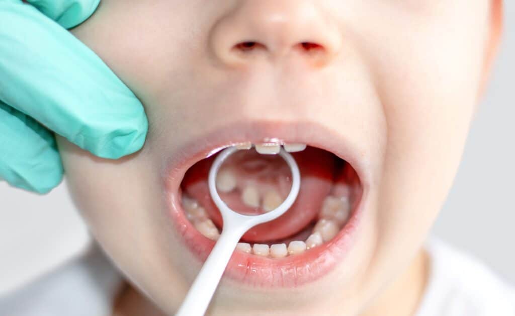 A pediatric dentist performs a dental check-up on a smiling preschool boy, using a mouth mirror and scaler to examine diastema and plan for extractions or spacers